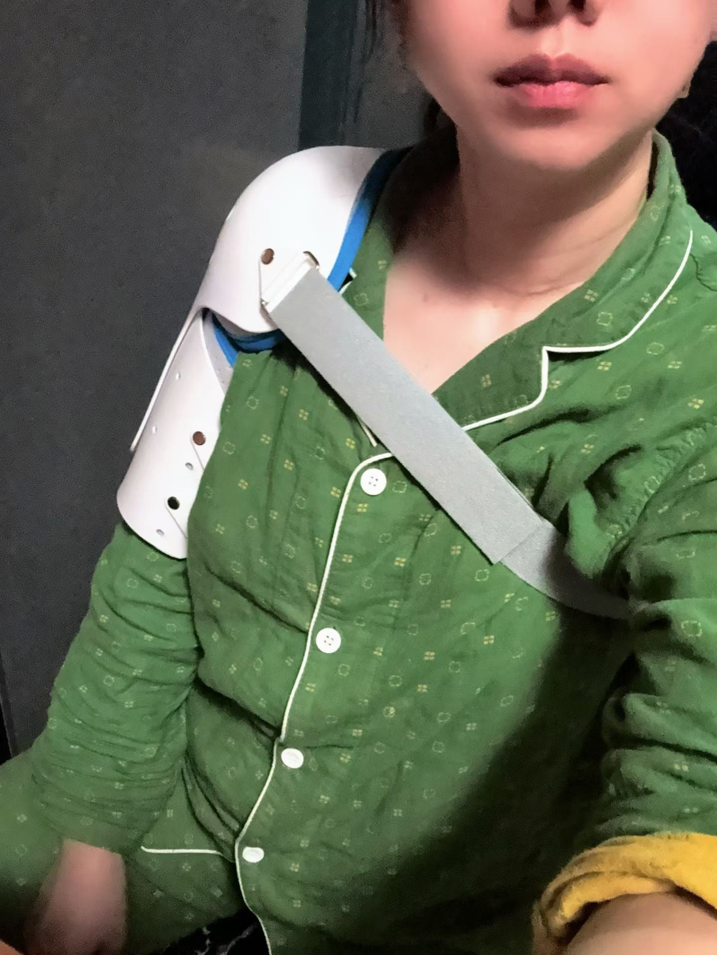 Adjustable Shoulder‑Elbow Fixed Orthosis Brace